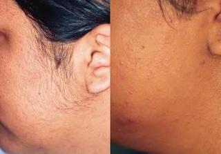 Laser hair removal before and after at Let's Face It Med Spa in Denver.