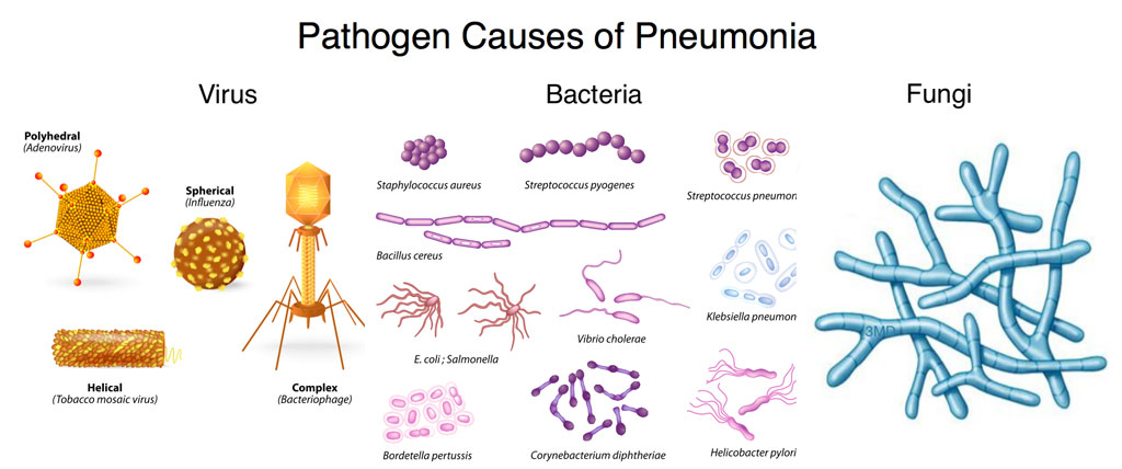 pathogen-causes-of-pneumonia.jpg