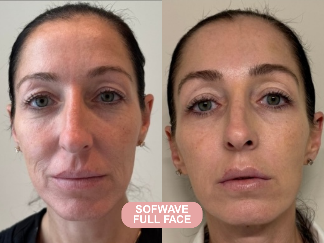 Sofwave before and after results at Let's Face It Med Spa