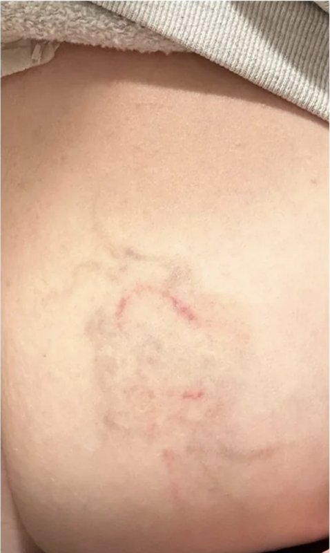 After 75% fading tattoo removal