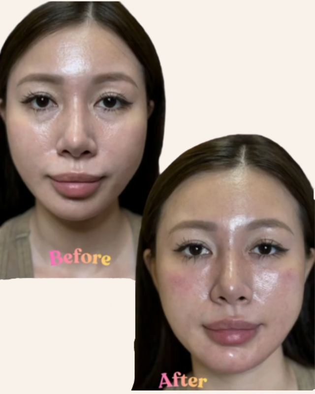 Facial contouring with Filler