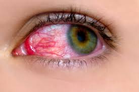 Red eye