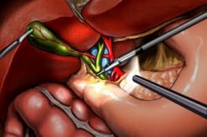 Colecistectomía Laparoscópica: Una Guía Completa sobre la Cirugía de Vesícula