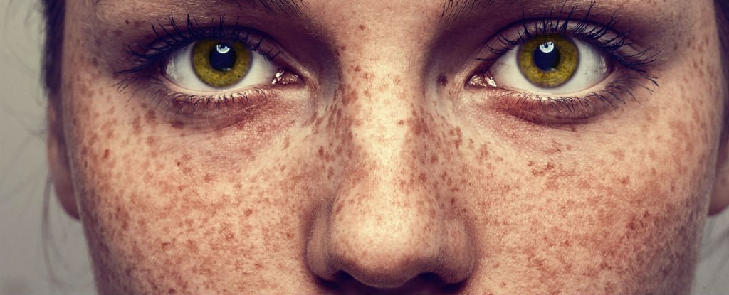 Freckle Analysis in Photography