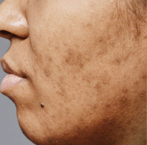 Hyperpigmentation