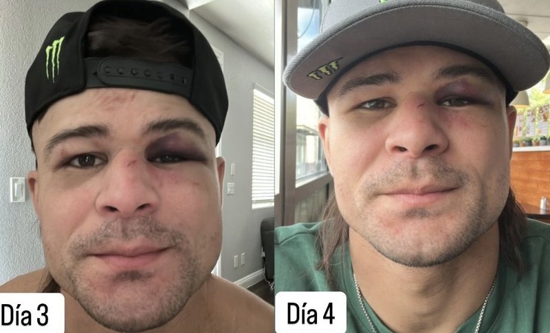 Диего Лопес показа как се възстановява лицето му след UFC 314