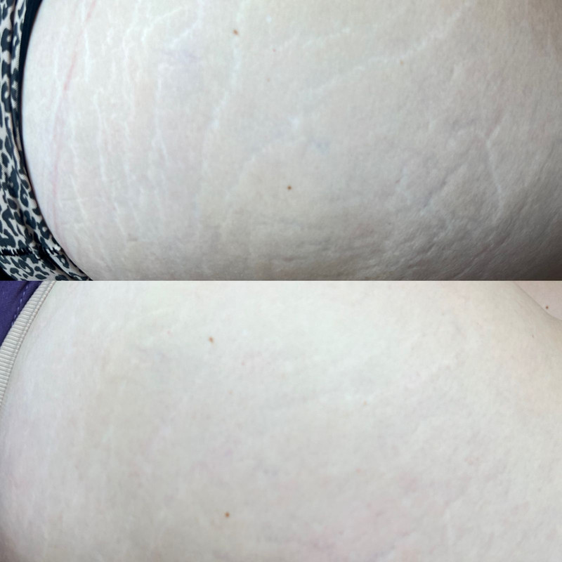 Tratamento para estrias