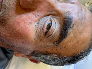 Before treatment