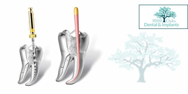 Root Canals