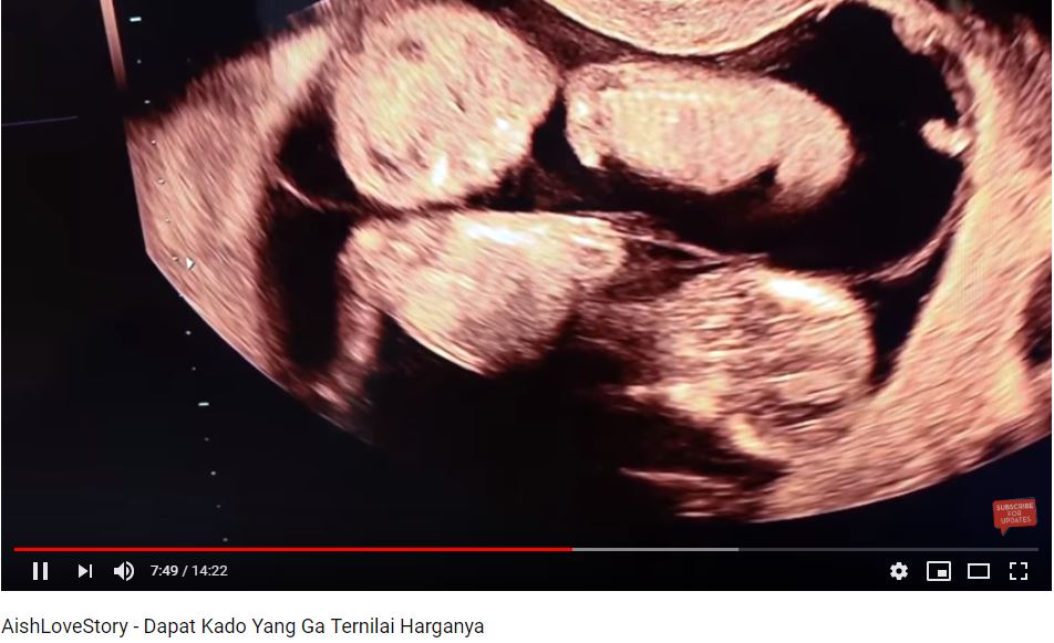 Ammar Zoni dan Irish Bella dikarunia anak kembar