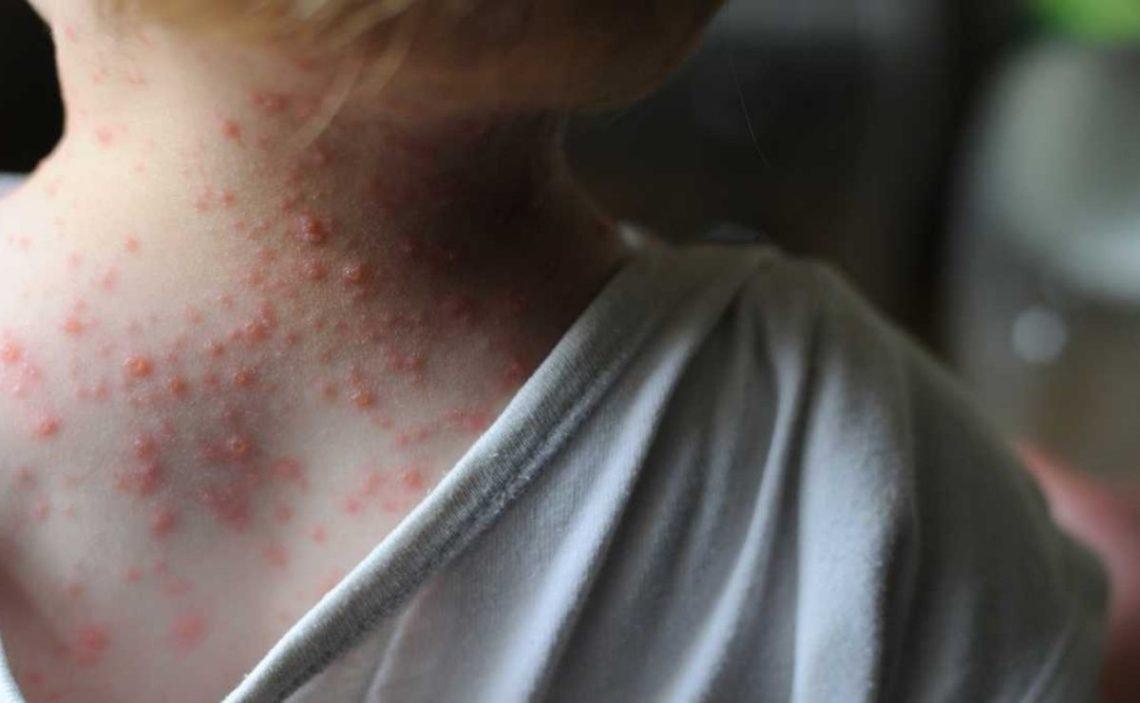 Propagación mundial de la viruela de mono podría no ser evitada, advierte OMS