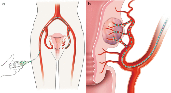 Эмболизация маточных артерий фото