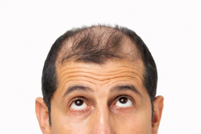 Hair Loss Treatment London