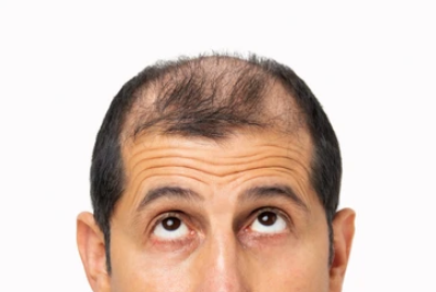 Hair Transplant Consultation London