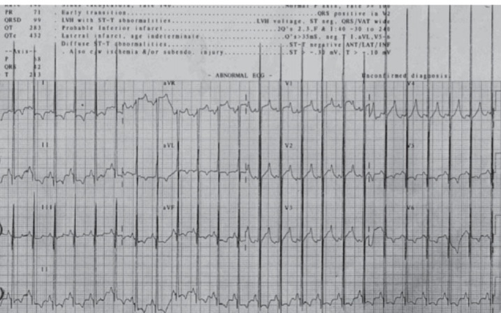 ECG showing Pompe Disease – short PR interval, giant QRS voltage, LVH, deep Q waves