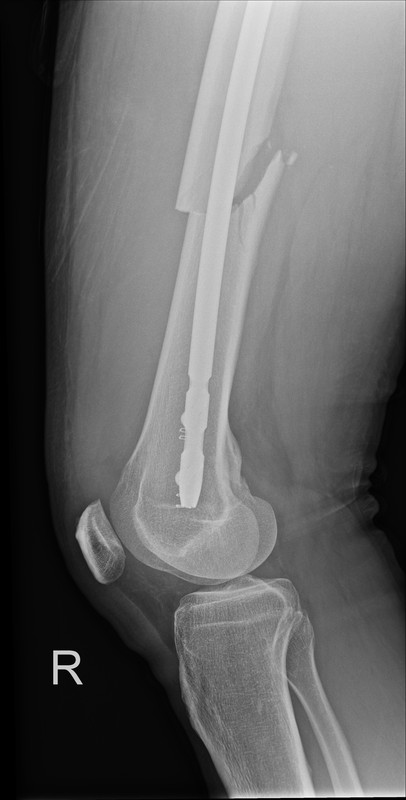 nach OP Nagel seitlich