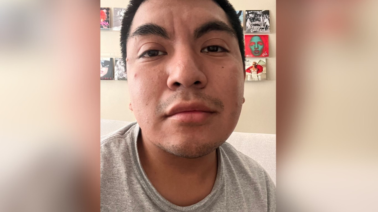 Maestro mexicano se contagia de viruela del mono; pide ayuda para cubrir gastos