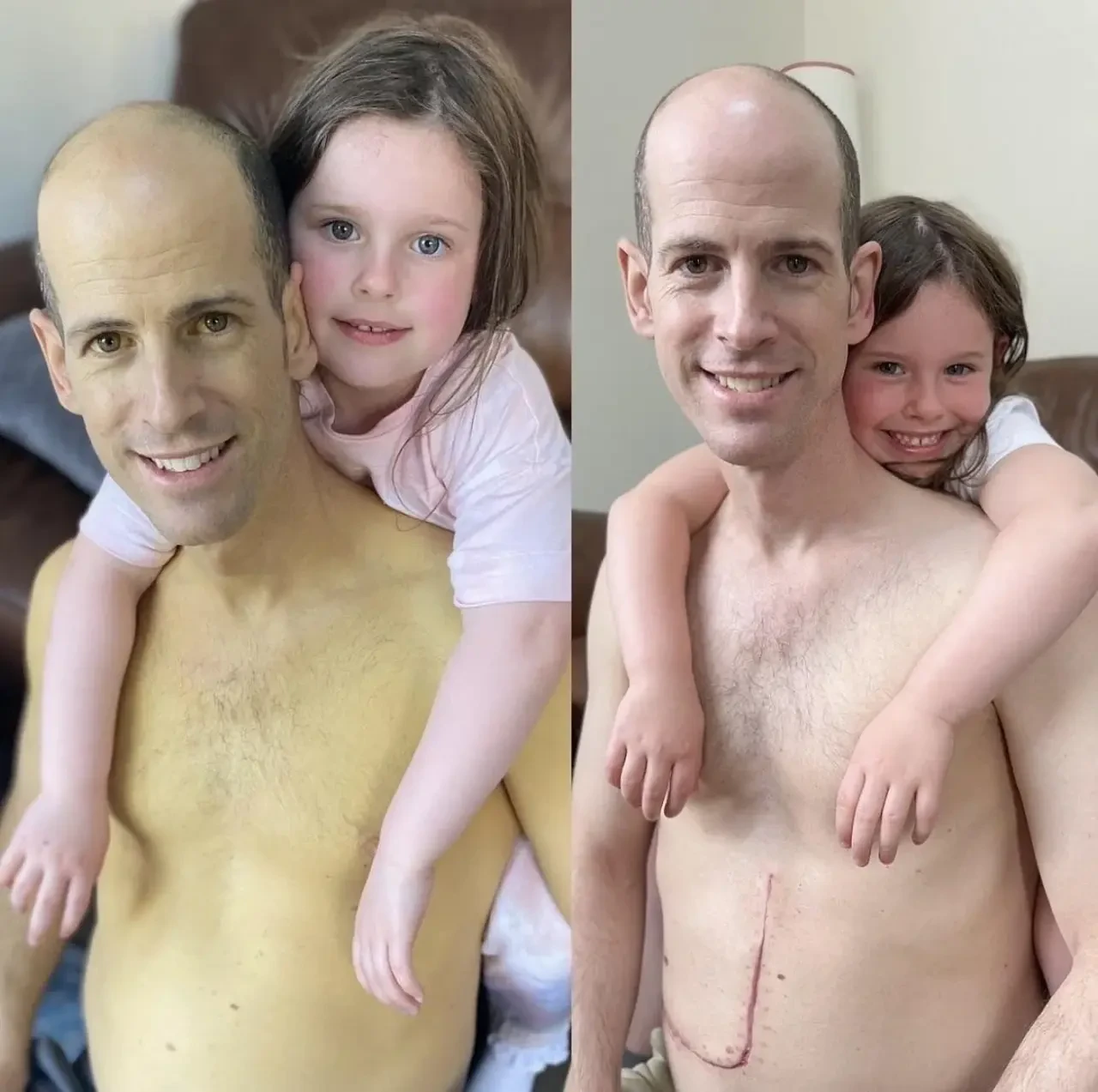liver-transplant