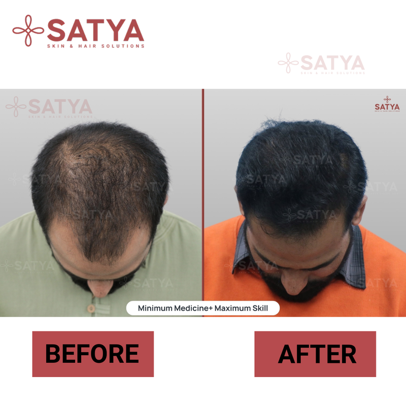 Hair Transplant Cost Per Graft India