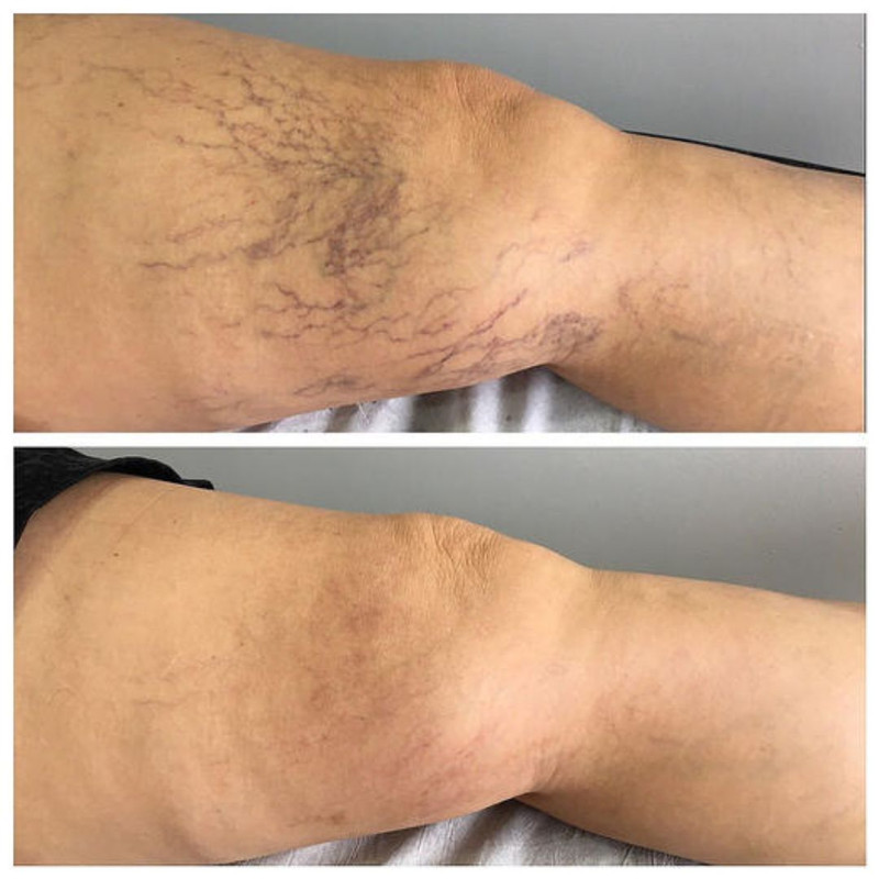 Resultado Variliss 4