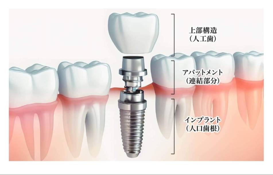 唐津市でインプラントなら大浦歯科へ