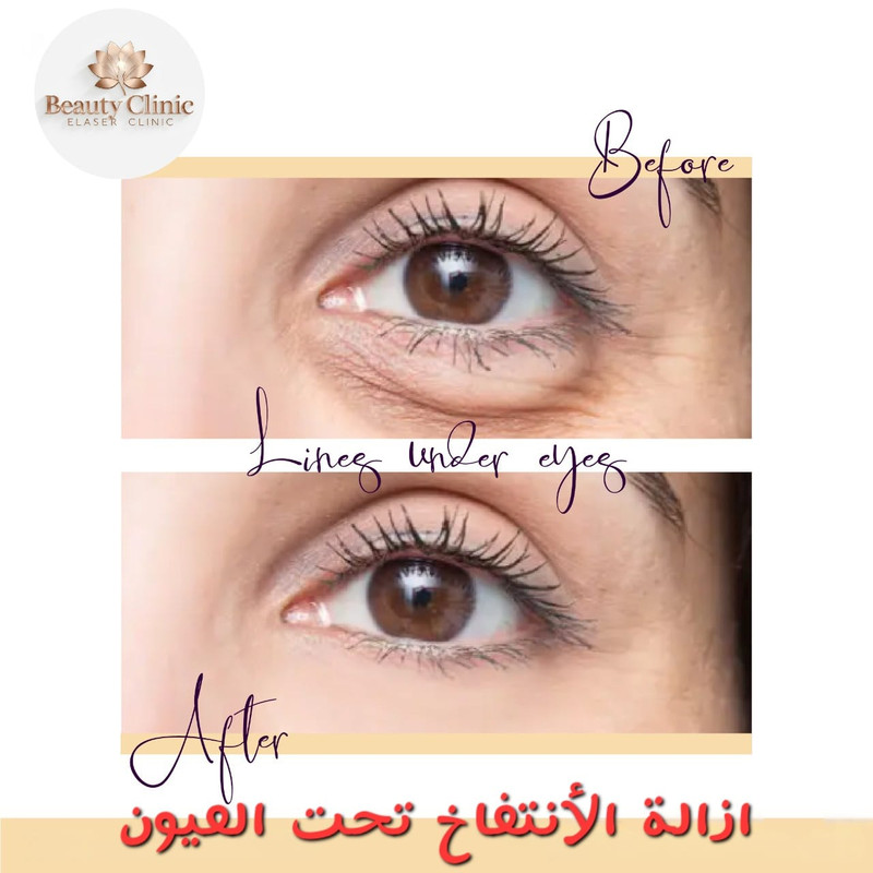 Under-Eye Puffiness Removal