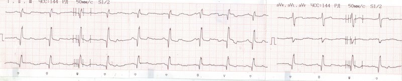 ЭКГ1
