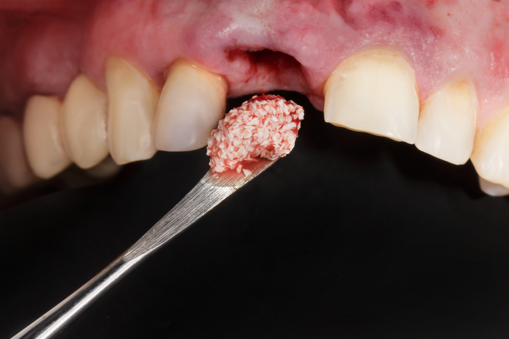 Sinus Lift & Bone Grafting