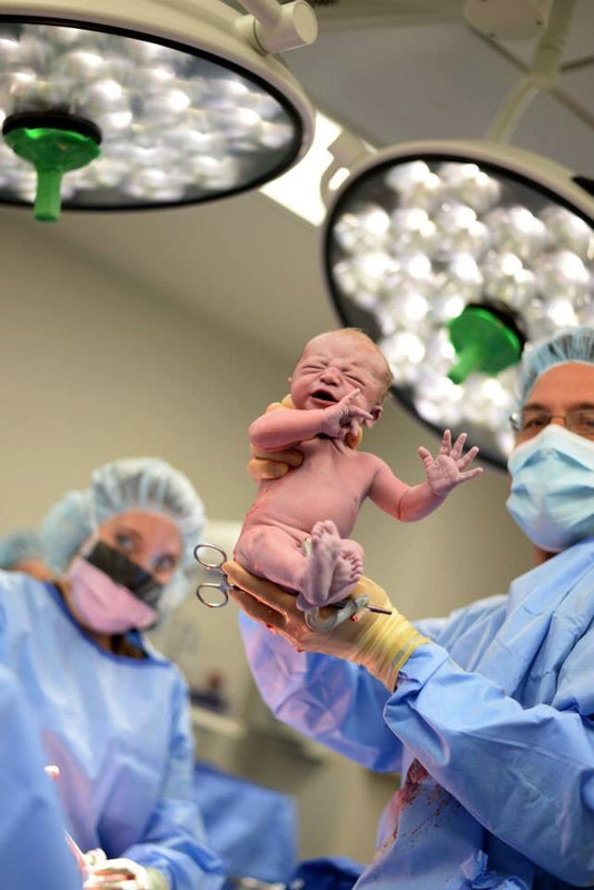 Cesarean