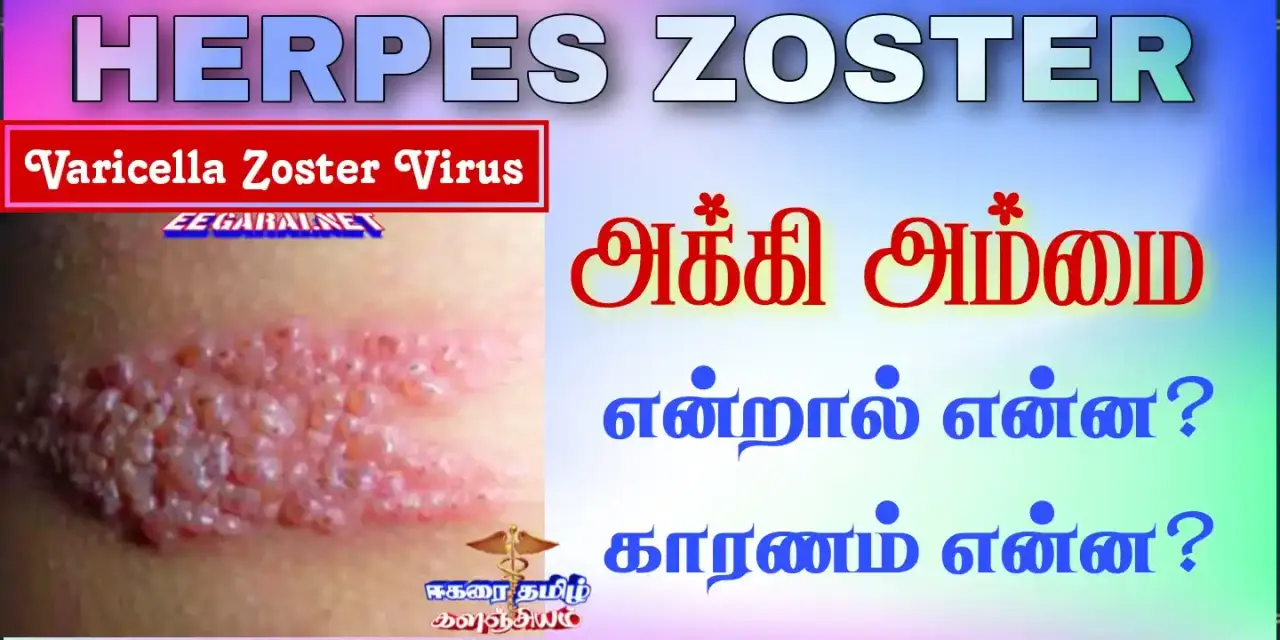Topics tagged under அக்கி_அம்மை on ஈகரை தமிழ் களஞ்சியம் Herpes-zoster