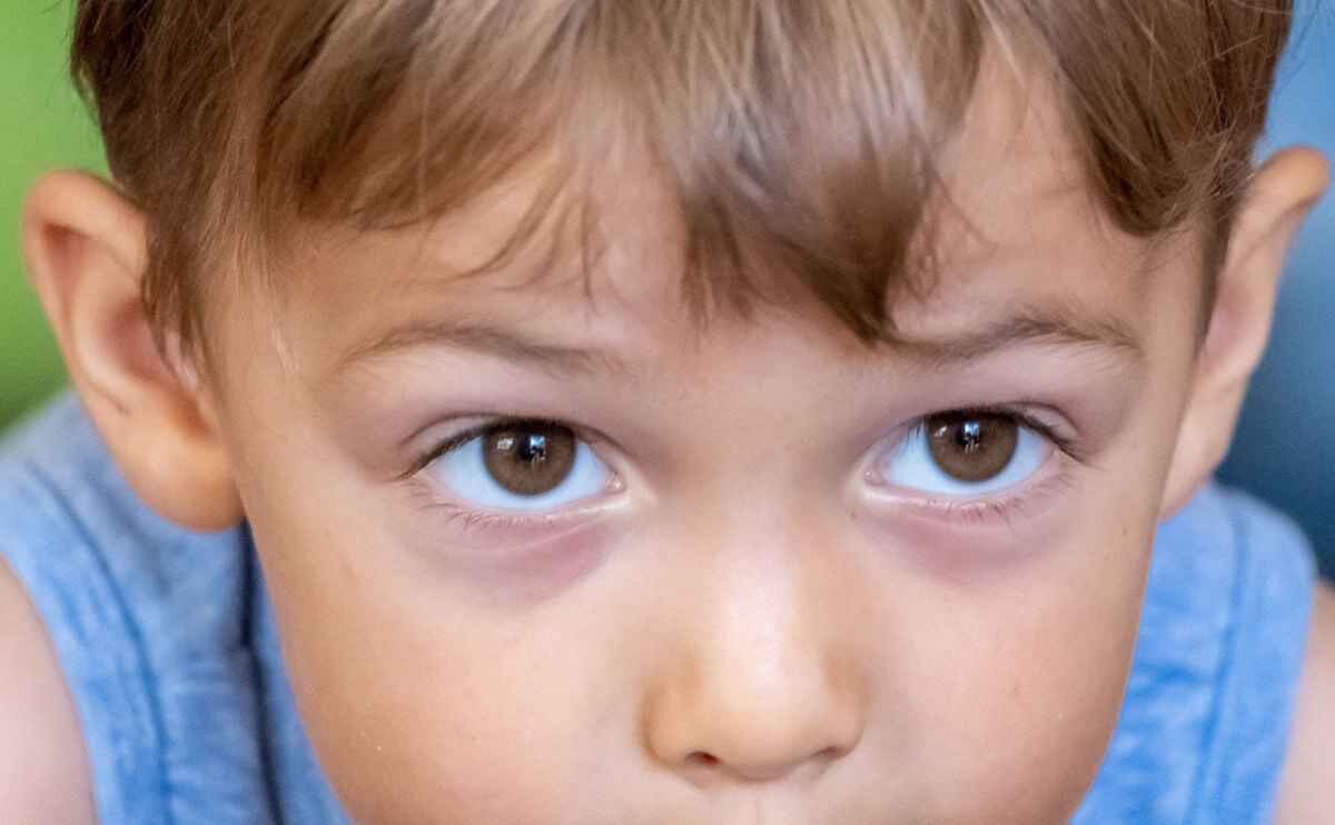 Dennie-Morgan infraorbital folds and allergic shiners – linear wrinkles beneath lower eyelashes with dark circles