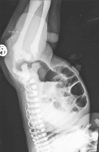 Invertogram for Anorectal Malformations – prone cross-table lateral x-ray