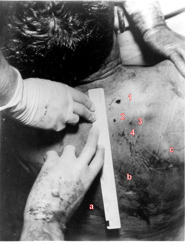 jfk-autopsy-back-wounds-x1.jpg