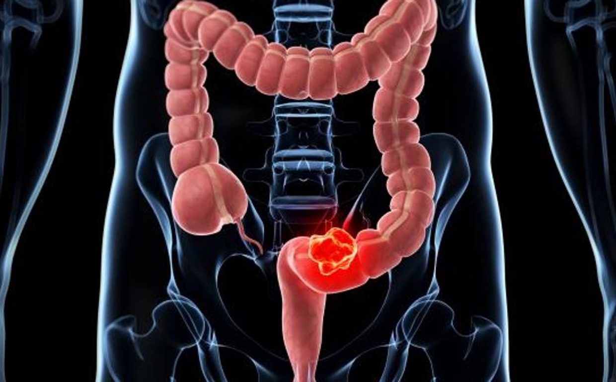 ¿Cuál es la diferencia entre el cáncer de colon y de recto?