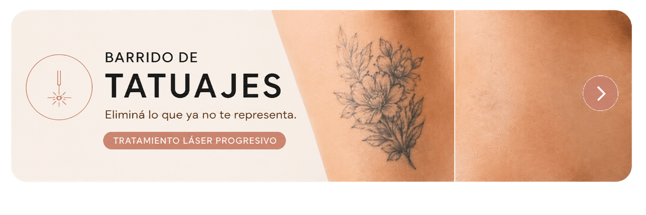 Banner barrido de tatuajes con láser en BELDAD Studio
