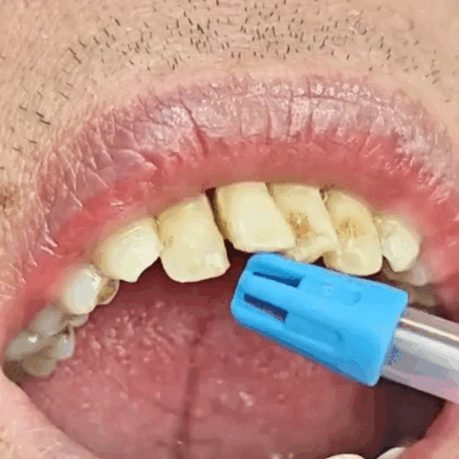 Periodontitis POV Experience