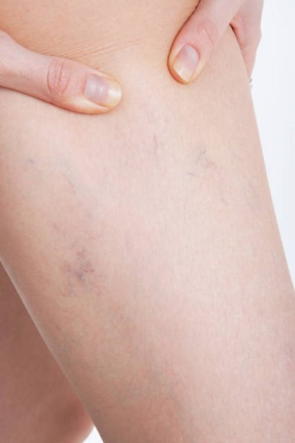 varicose veins