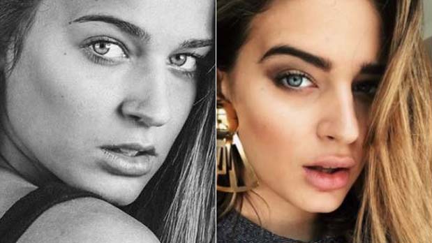 relleno-labios-escanes (1)