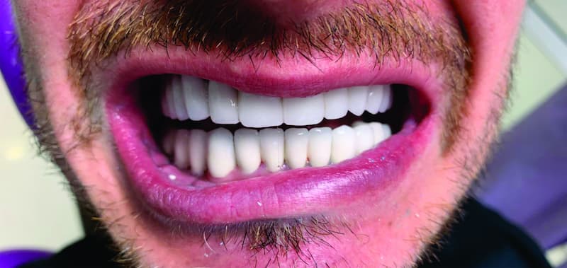 Rezultat nakon tretmana — Hollywood smile i implantati