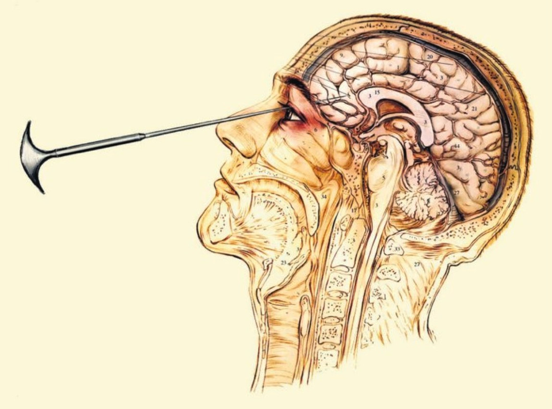 lobotomy