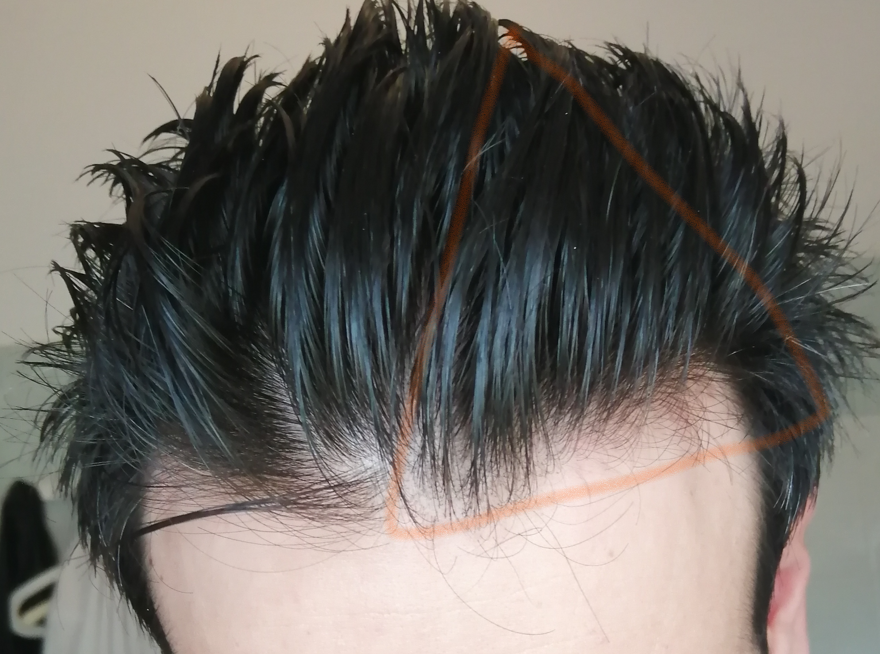 17. luglio 24. Zona cerchiata per farvi capire che la parte sx era ancora integra