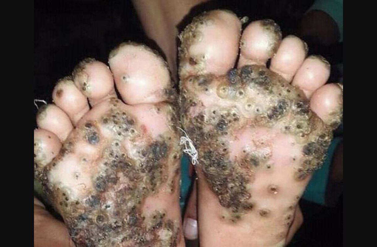 Vacaciones le deja rara enfermedad, médico narra el padecimiento