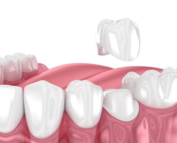 Microstructural Failure Patterns: Can You Put a Crown on a Broken Tooth?