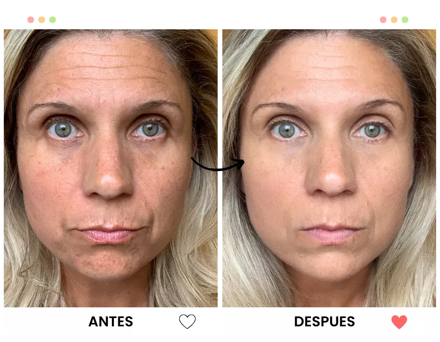 Antes y después - Lifting Pro Duo