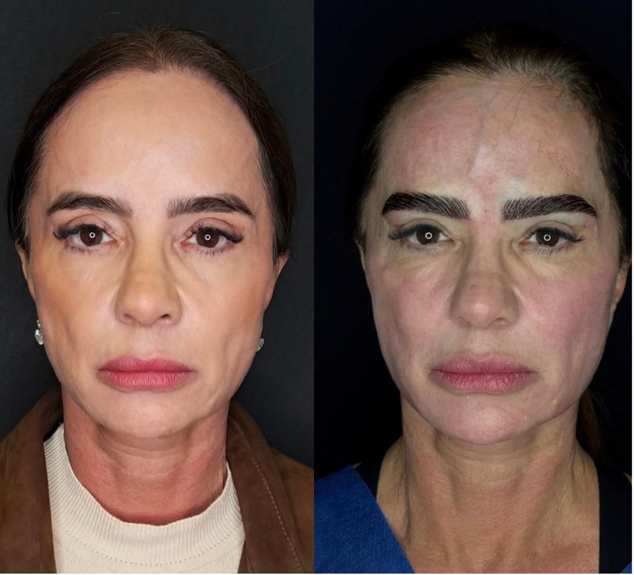Resultado de transplante de sobrancelhas 1