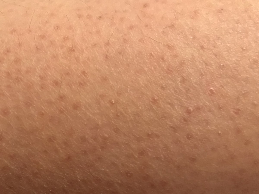 1200px-Keratosis_pilaris_(moderate)