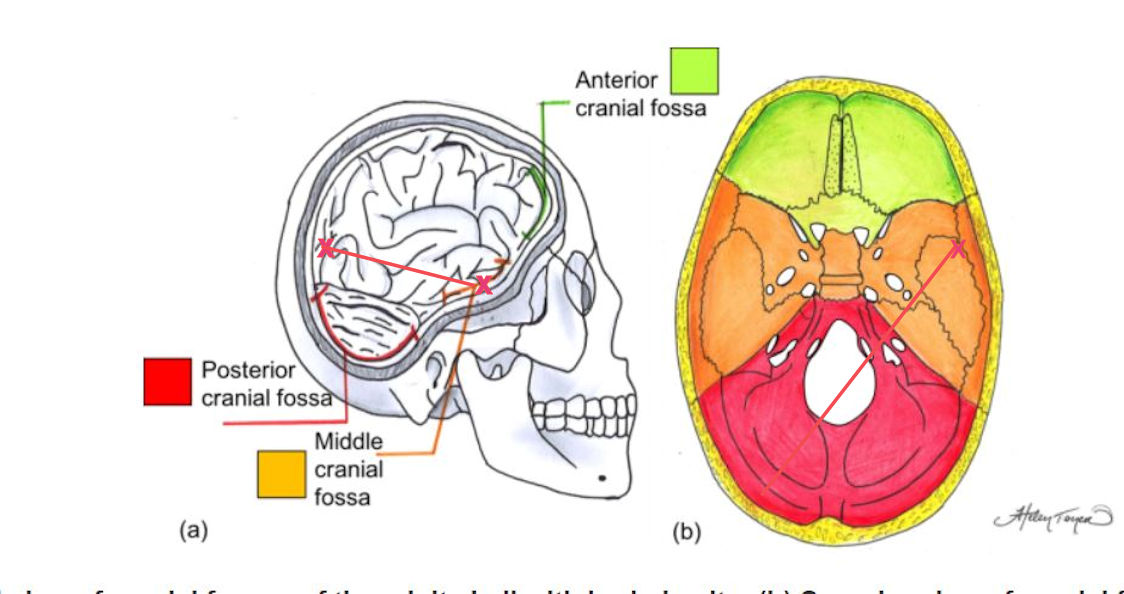 middle-cranial-fossa-a.jpg