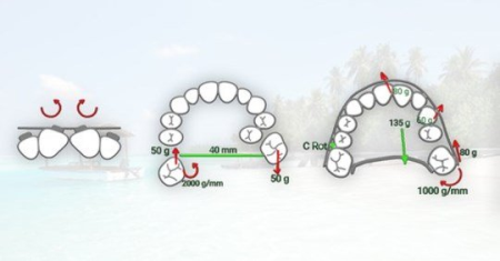 Adult Orthodontic Treatment. Minor tooth movement.