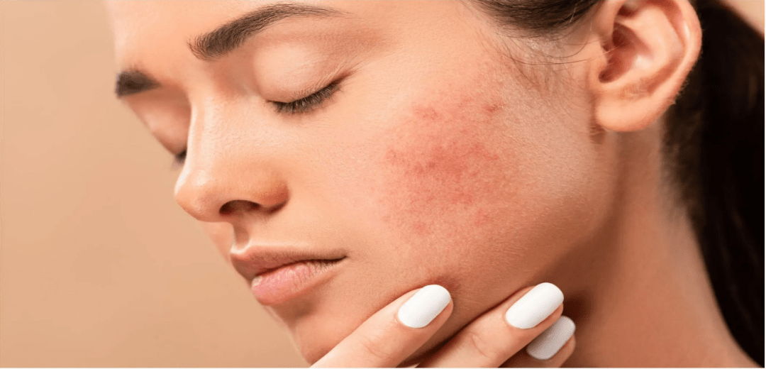 Remove Dark Spots Caused by Pimples