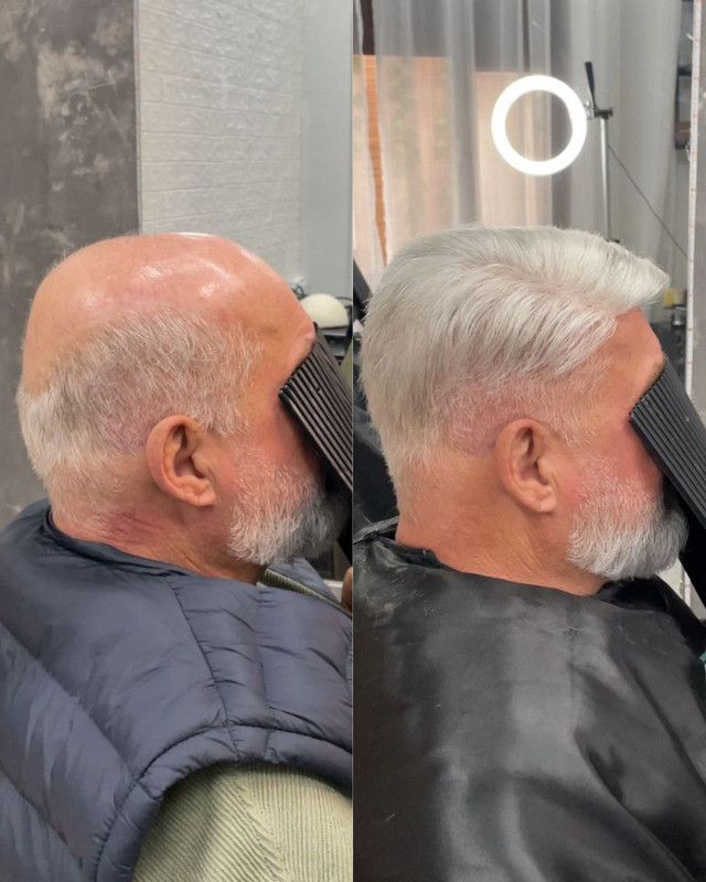 Antes e Depois Prótese Capilar em Nova Friburgo